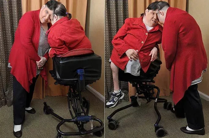 Сиамские близнецы Шаппелл